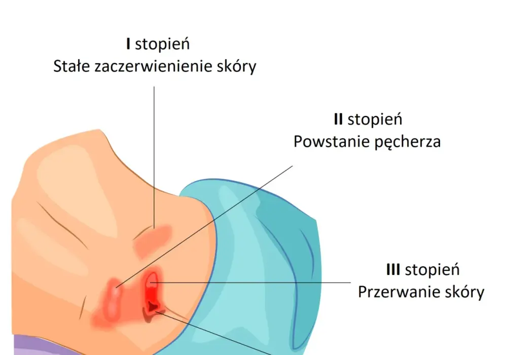 Czy odleżyny prowadzą do śmierci? Poznaj ryzyko powikłań i zapobieganie