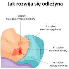 Czy odleżyny prowadzą do śmierci? Poznaj ryzyko powikłań i zapobieganie